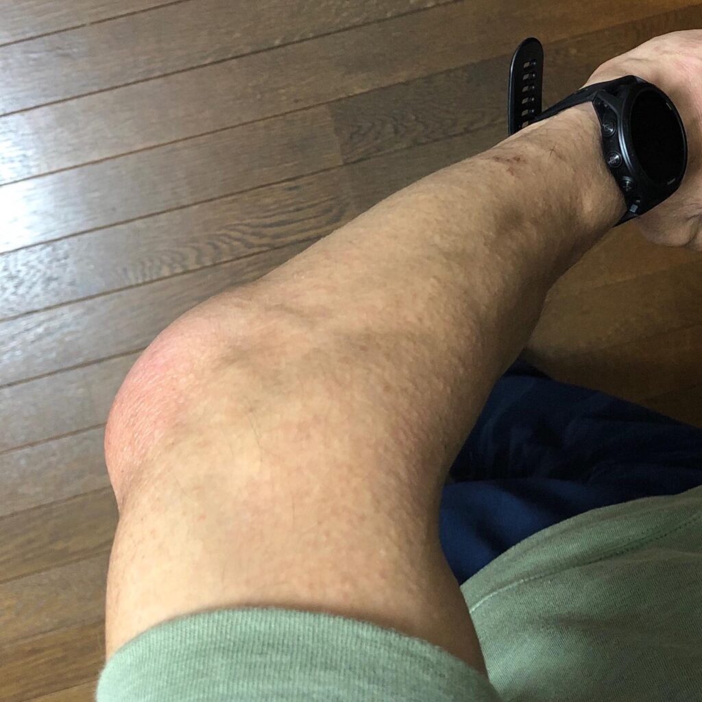 10/20に突然肘がめちゃくちゃ腫れたw なんと蜂窩織炎。抗生物質を投入することに。